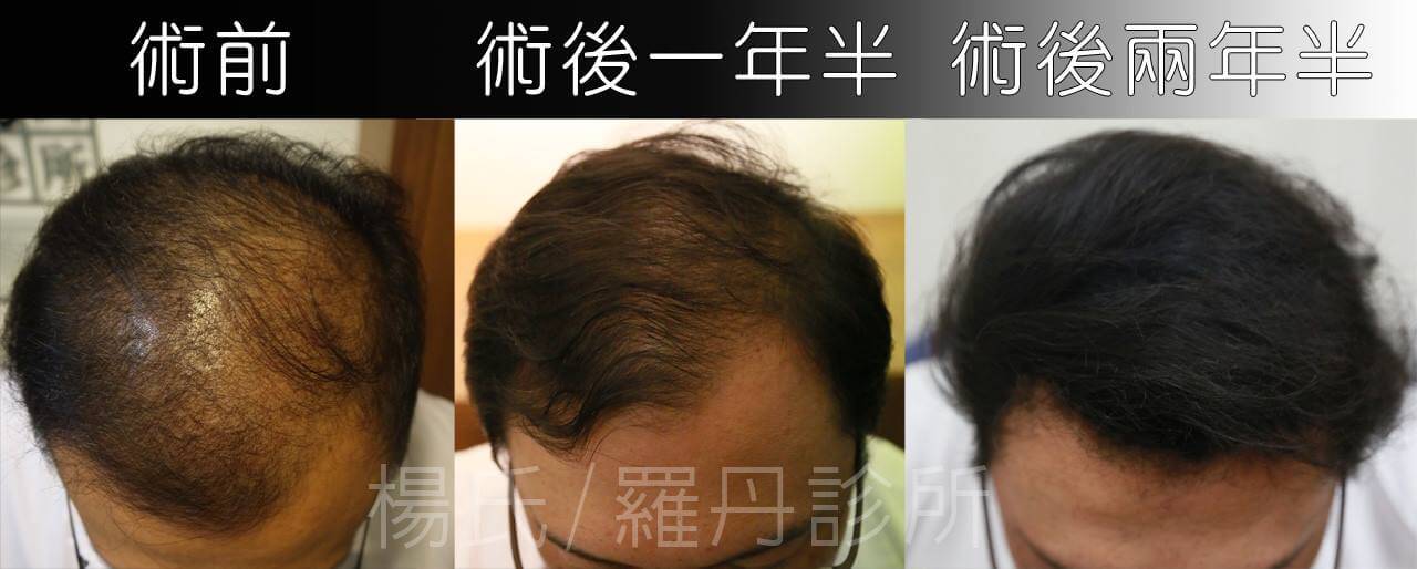 台灣醫師初體驗 - ARTAS植髮